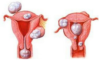患有子宫肌瘤对怀孕有影响吗