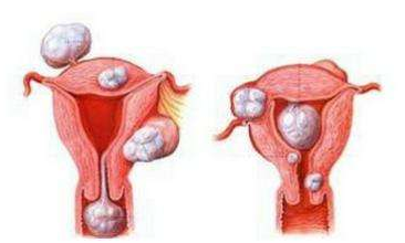 子宫肌瘤会影响女性怀孕吗
