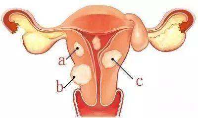 女性子宫肌瘤要怎么预防